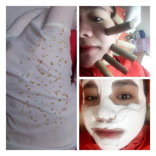 Công Nghệ Nặn Mụn Ống Tre - Bí Quyết Làm Đẹp Da Hiệu Quả Tại Bích Lê Spa