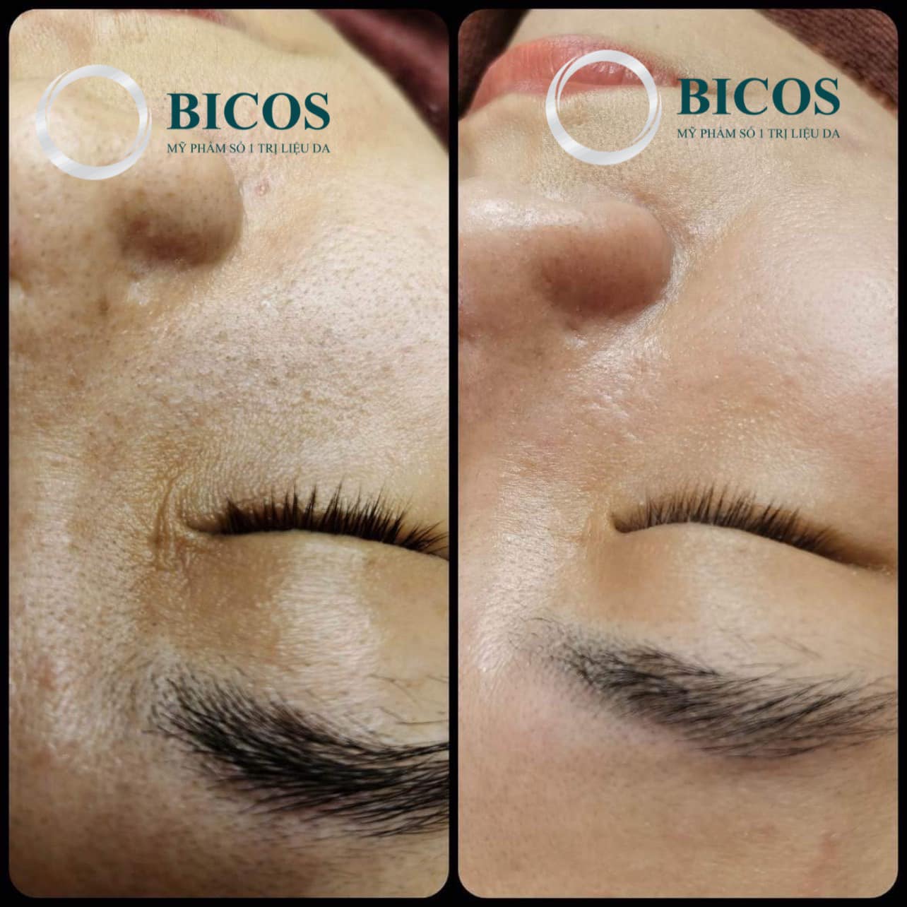 Kết quả các dịch vụ chăm sóc - điều trị da tại Mai House