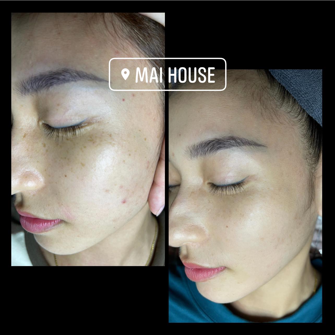 Kết quả các dịch vụ chăm sóc - điều trị da tại Mai House