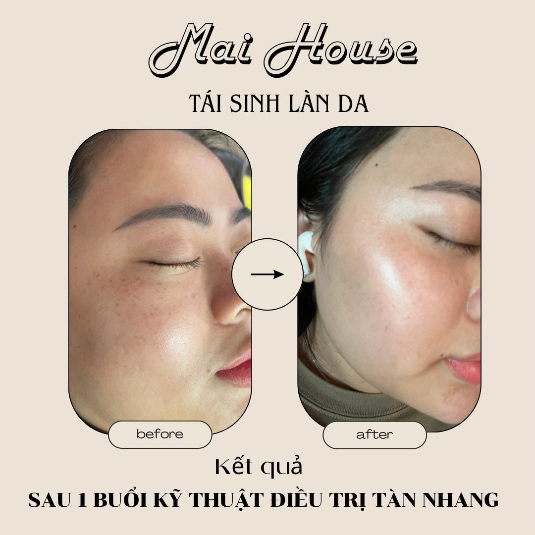 Kết quả các dịch vụ chăm sóc - điều trị da không đều mầu tại Mai House