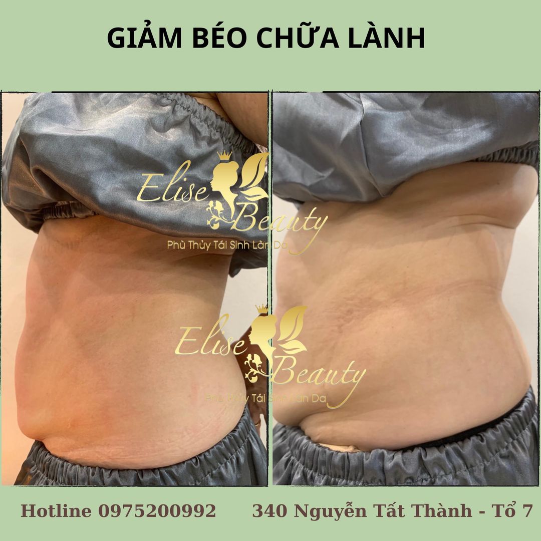 Dịch vụ giảm béo