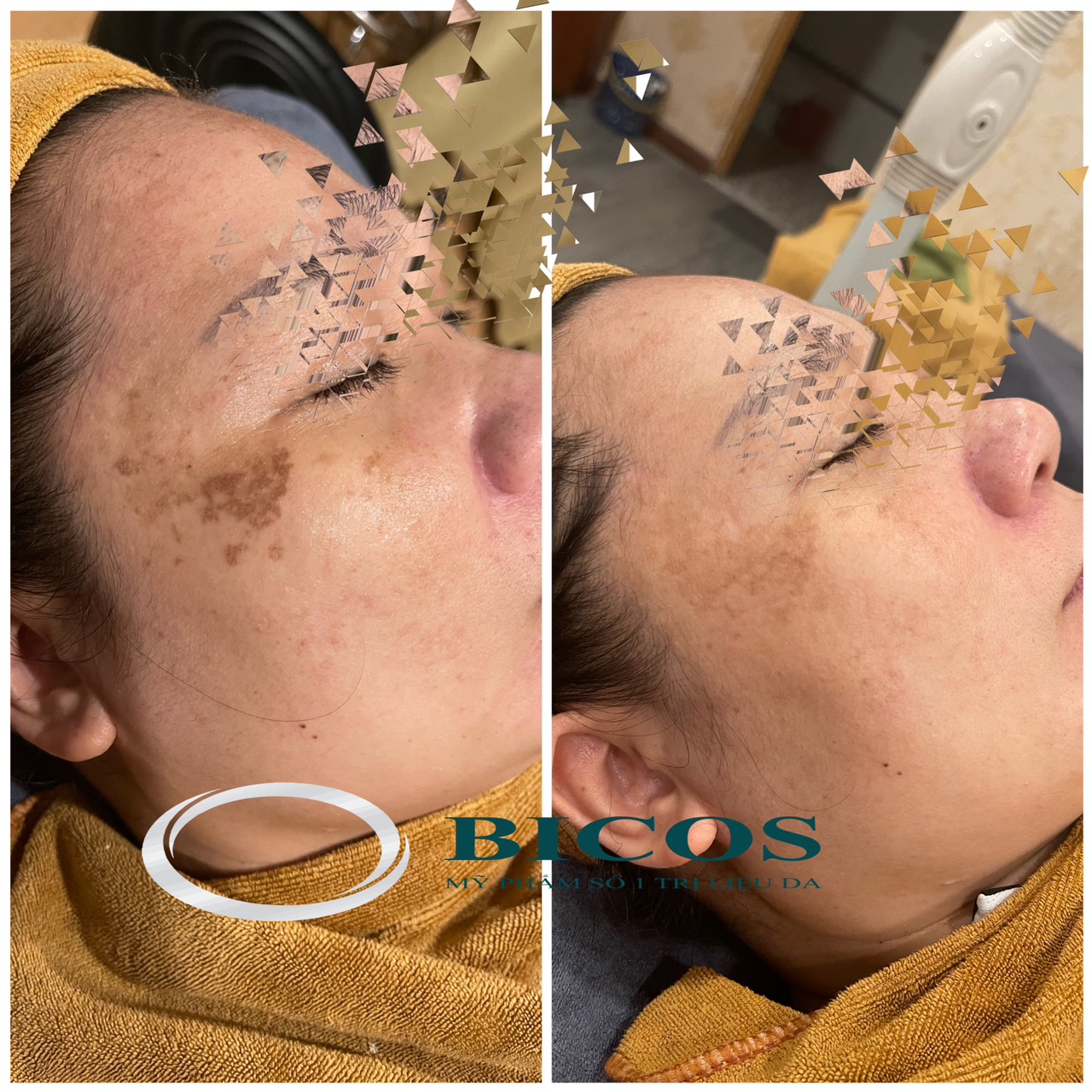 Dịch Vụ Trị Nám