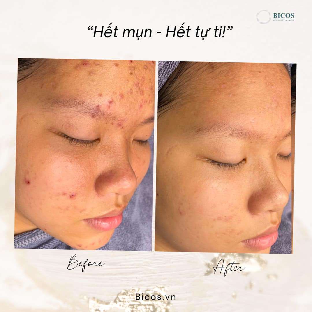 Dịch Vụ ĐIều Tri Thâm Do Mụn