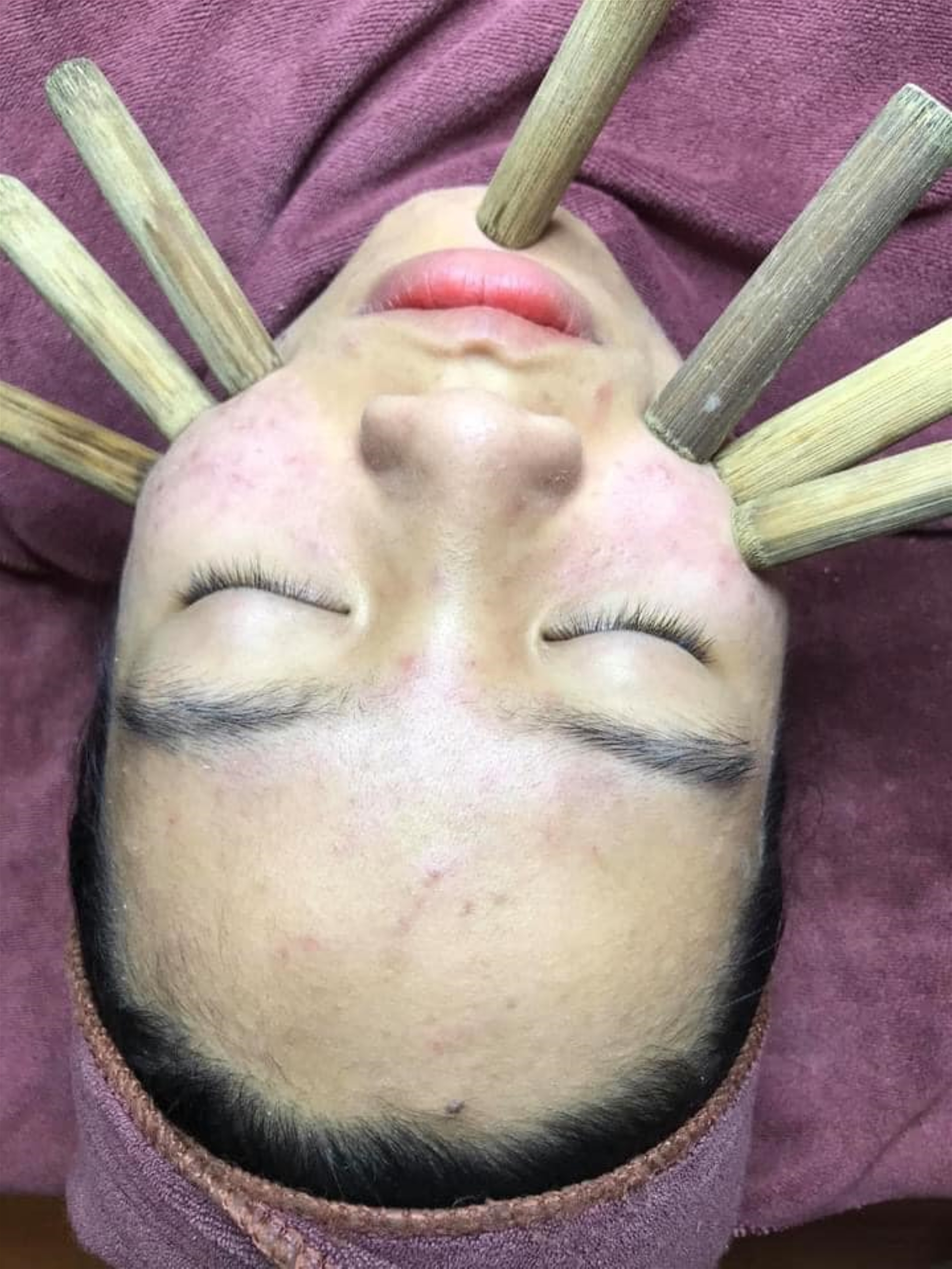 Nặn Mụn Lăn Ống Tre