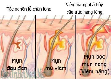 NHỮNG SAI LẦM LÀM LỖ CHÂN LÔNG TO